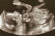Депутат предлагает наделить эмбрионы человеческими правами